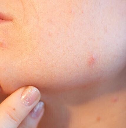 Z trądzikiem młodzieńczym można się uporać