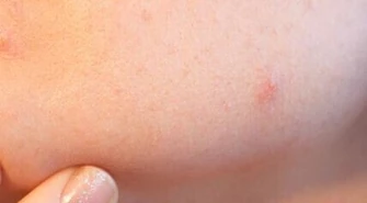 Z trądzikiem młodzieńczym można się uporać