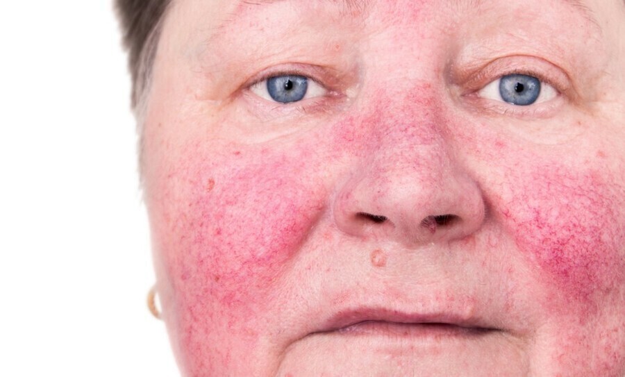 Trądzik różowaty - jak wyleczyć Poznaj Opinie o Acnerose