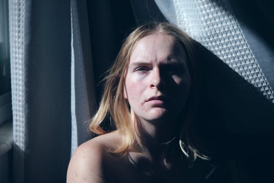 Cera trądzikowa - jak ją zwalczyć