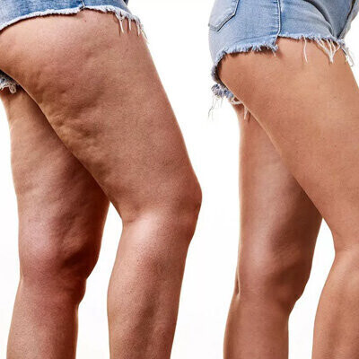 Leczenie trądziku domowe sposoby na cellulit