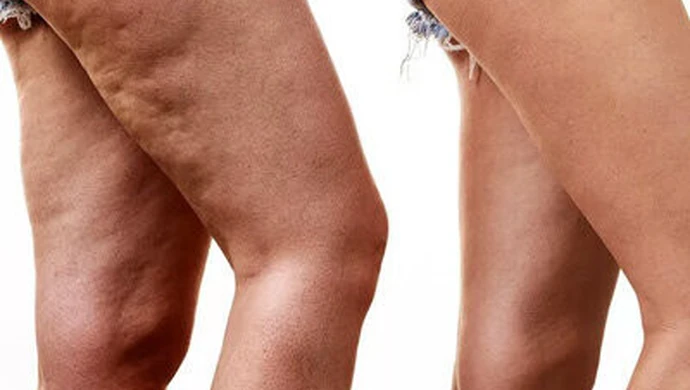 Leczenie trądziku, domowe sposoby na cellulit