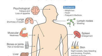 Co musisz wiedzieć o białaczce?