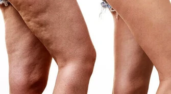 Leczenie trądziku, domowe sposoby na cellulit