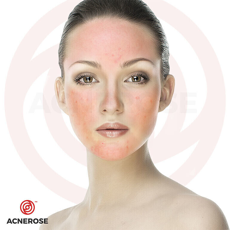 Kosmetyki na trądzik różowaty. Przedstawiamy skuteczne