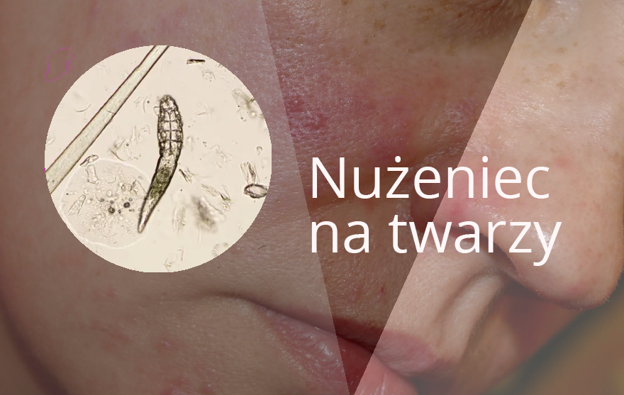 Nużeniec na twarzy sprawdź co warto wiedzieć