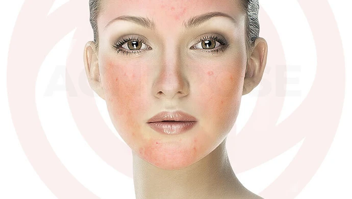 Kosmetyki na trądzik różowaty. Przedstawiamy skuteczne