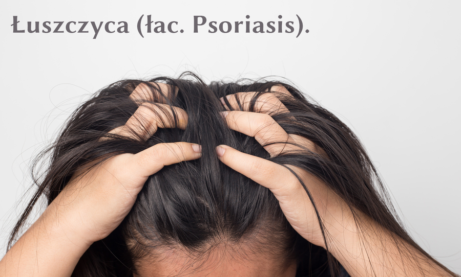 Szampon na łuszczycę - jak działa