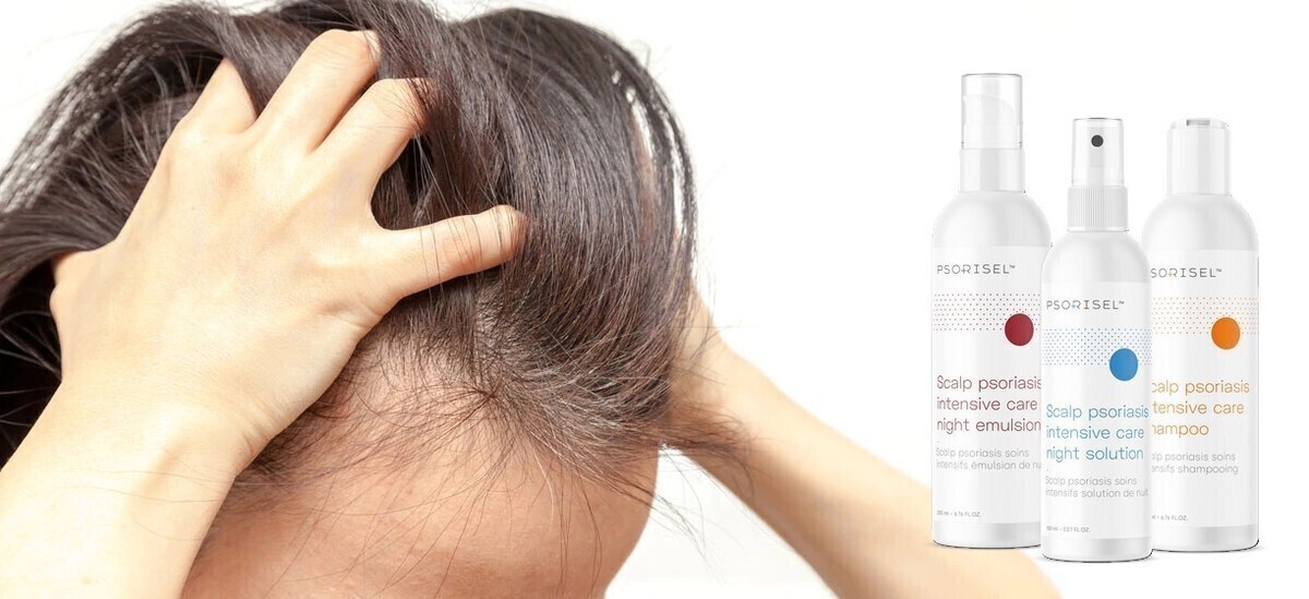 Łuszczyca głowy- na czym polega