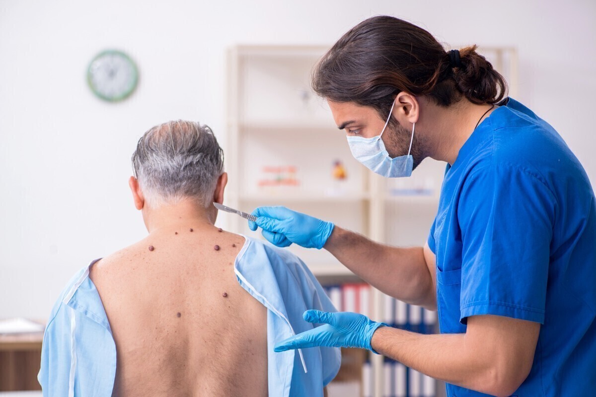 Bezbolesne usuwanie znamion czy jest możliwe I jak przebiega