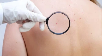 Bezpieczne usuwanie pieprzyków Warszawa - co musisz wiedzieć?