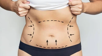 Liposukcja brzucha Łódź - jak się przygotować